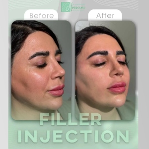 filler-injection-1
