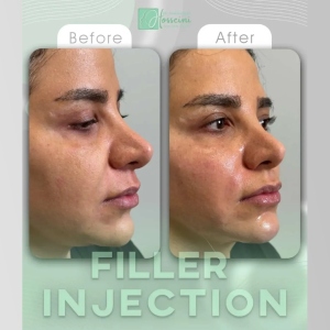 filler-injection-10