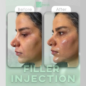 filler-injection-11