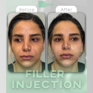 filler-injection-12