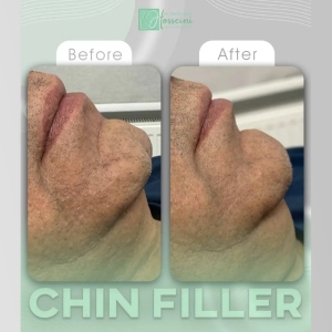 filler-injection-13