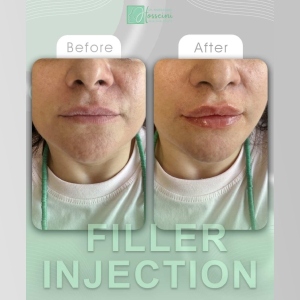 filler-injection-15