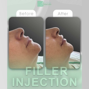 filler-injection-16