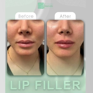 filler-injection-17