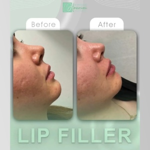 filler-injection-18
