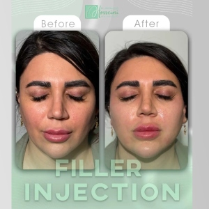 filler-injection-2
