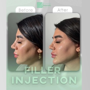 filler-injection-3
