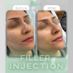 filler-injection-4
