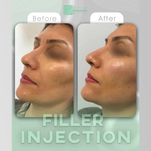 filler-injection-5
