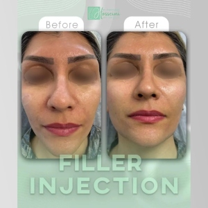 filler-injection-6