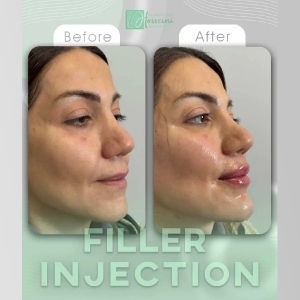 filler-injection-7