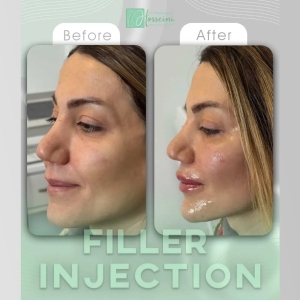 filler-injection-8