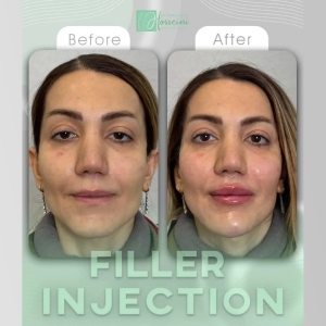 filler-injection-9