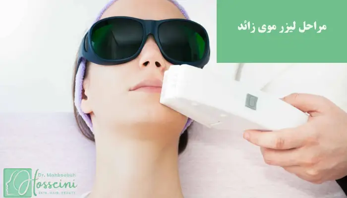 مراحل لیزر موهای زائد