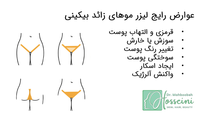 لیستی از عوارض لیزر موهای زائد بیکینی همرا با تصویر شماتیک