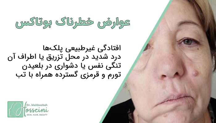 عوارض خطرناک بوتاکس