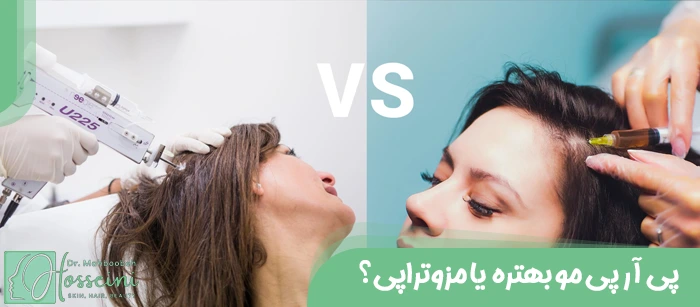 پی آر پی مو بهتره یا مزوتراپی؟