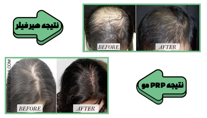 تفاوت prp با هیر فیلر