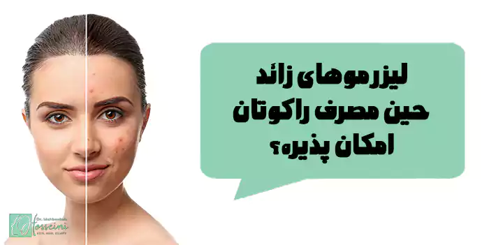 لیزر موهای زائد حین مصرف راکوتان امکان پذیره؟