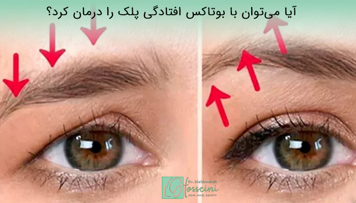 آیا می‌توان با بوتاکس افتادگی پلک را درمان کرد