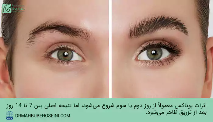 بالا رفتن یک ابرو بعد از تزریق بوتاکس