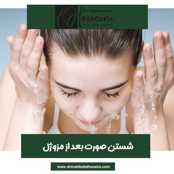 شستن صورت بعد از مزوژل