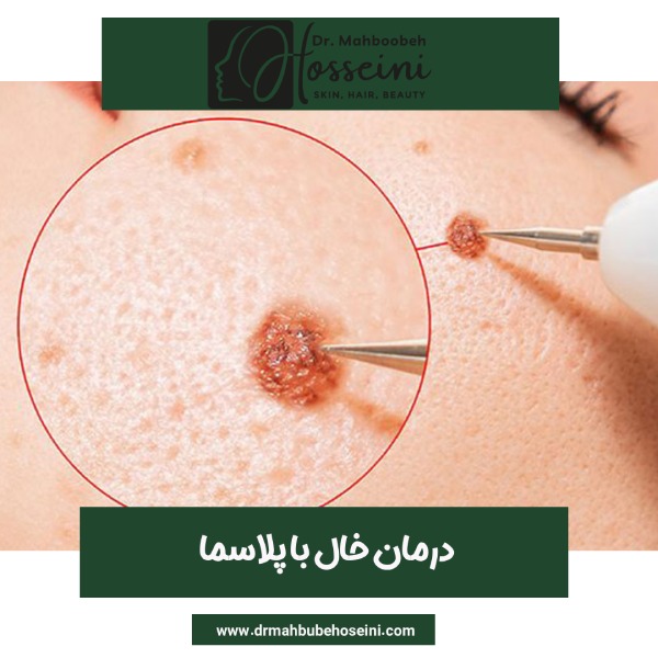 درمان خال با پلاسما